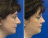Revision Rhinoplasty