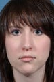 Revision Rhinoplasty