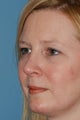 Revision Rhinoplasty