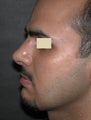 Revision Rhinoplasty