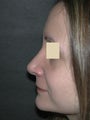 Nose surgery revision 