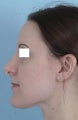 Revision Rhinoplasty 