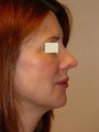 Revision Rhinoplasty