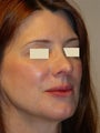 Revision Rhinoplasty