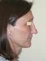 Reconstructive rhinoplasty