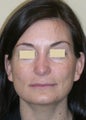 Reconstructive Secondary Rhinoplasty with Chin Implant