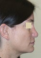 Reconstructive Secondary Rhinoplasty  with Chin Implant