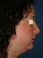 Revision Rhinoplasty