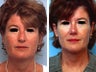 Rhinoplasty revision