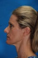 Revision Rhinoplasty