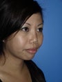Revision Rhinoplasty with Chin Implant
