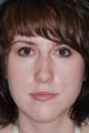 Revision Rhinoplasty