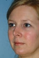 Revision Rhinoplasty