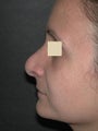 Nose surgery revision 