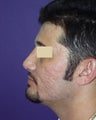 Nasal revison surgery