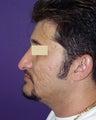 Nasal revison surgery