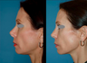 Revision Rhinoplasty (open)