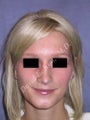 Rhinoplasty