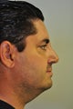 Revision Rhinoplasty