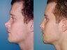 Revision rhinoplasty