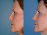 Revision rhinoplasty