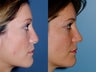 Revision rhinoplasty
