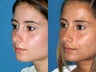 Revision rhinoplasty