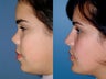 Revision rhinoplasty