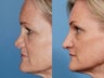 Revision rhinoplasty