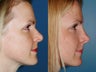 Revision rhinoplasty
