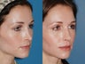 Revision rhinoplasty