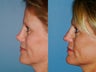 Revision rhinoplasty