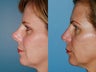 Revision rhinoplasty