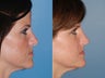 Revision rhinoplasty