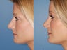 Revision rhinoplasty