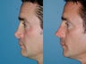 Revision rhinoplasty