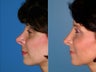 Revision rhinoplasty