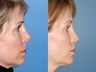 Revision rhinoplasty