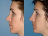 Revision rhinoplasty