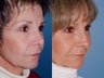 Revision rhinoplasty