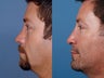 Revision rhinoplasty