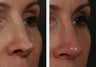 Revision Rhinoplasty