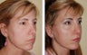 Revision Rhinoplasty