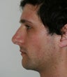 Rhinoplasty revision