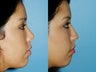 Revision rhinoplasty
