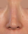 Revision Rhinoplasty