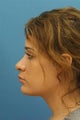 Revision Rhinoplasty