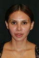 Rhinoplasty revision 