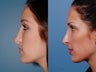 Revision rhinoplasty