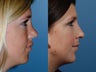 Revision rhinoplasty